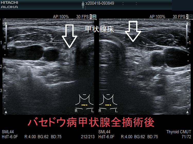 バセドウ病/甲状腺機能亢進症の手術療法（甲状腺全摘出）[橋本病 エコー 長崎甲状腺クリニック 大阪]