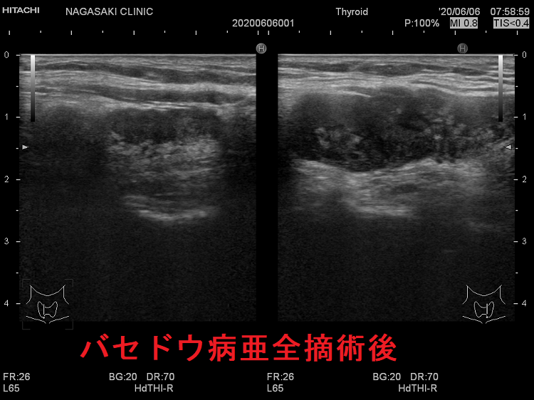 バセドウ病/甲状腺機能亢進症の手術療法（甲状腺全摘出）[橋本病 エコー 長崎甲状腺クリニック 大阪]