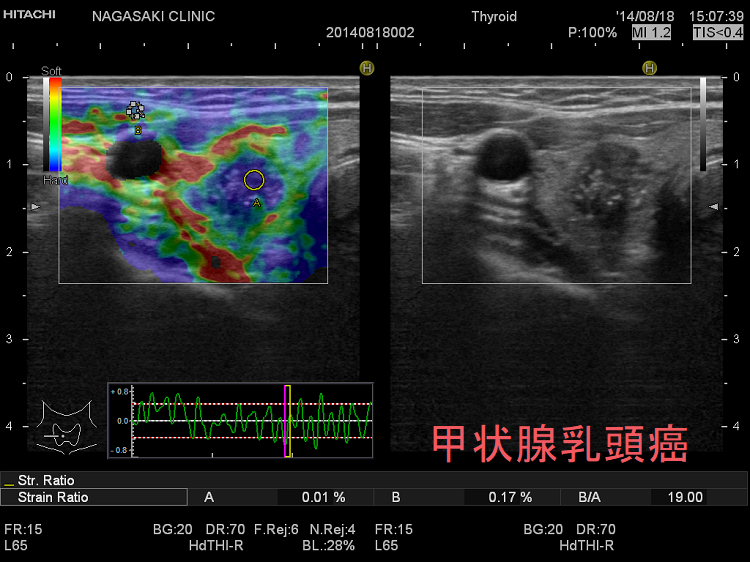 甲状腺：専門の検査 治療①[橋本病 バセドウ病 超音波 エコー 長崎甲状腺クリニック 大阪]