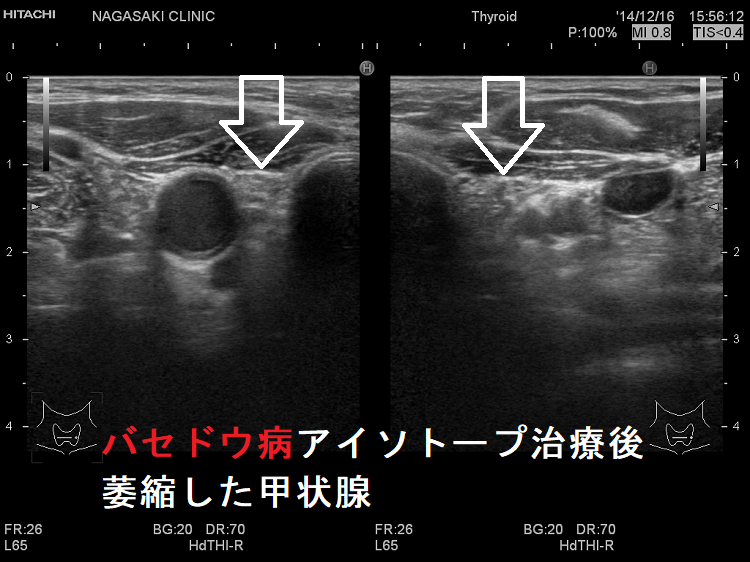 バセドウ病/甲状腺機能亢進症のアイソトープ（放射性ヨウ素;I-131）治療[長崎甲状腺クリニック大阪