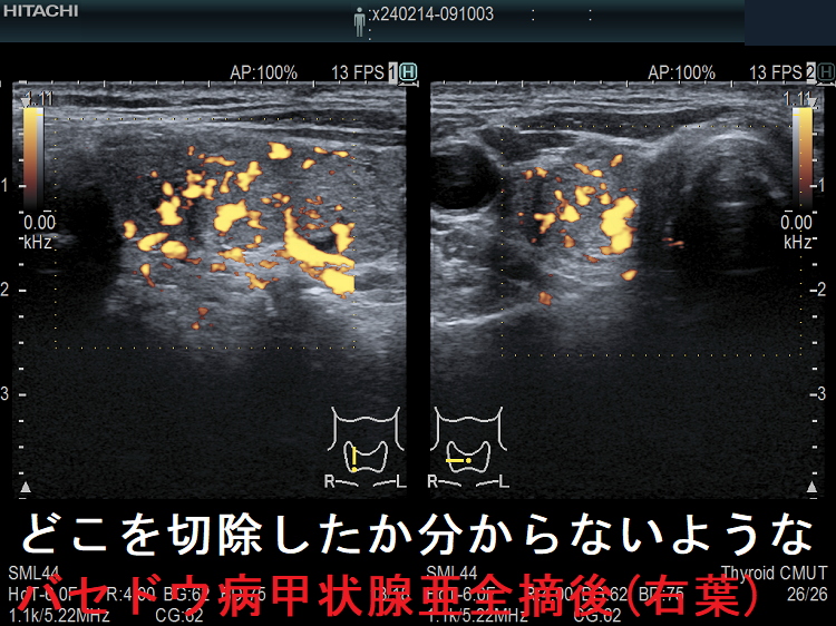 バセドウ病/甲状腺機能亢進症の手術療法（甲状腺全摘出）[橋本病 エコー 長崎甲状腺クリニック 大阪]