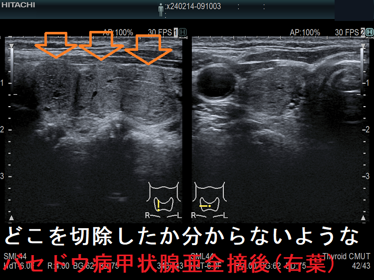 バセドウ病/甲状腺機能亢進症の手術療法（甲状腺全摘出）[橋本病 エコー 長崎甲状腺クリニック 大阪]