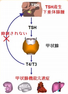 TSH産生下垂体神経内分泌腫瘍(原因,症状,甲状腺癌,治療),TSH不適切分泌 