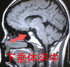 下垂体腫瘍と視神経障害・下垂体卒中・副鼻腔炎で下垂体機能低下症（下垂体膿瘍）[長崎甲状腺クリニック]