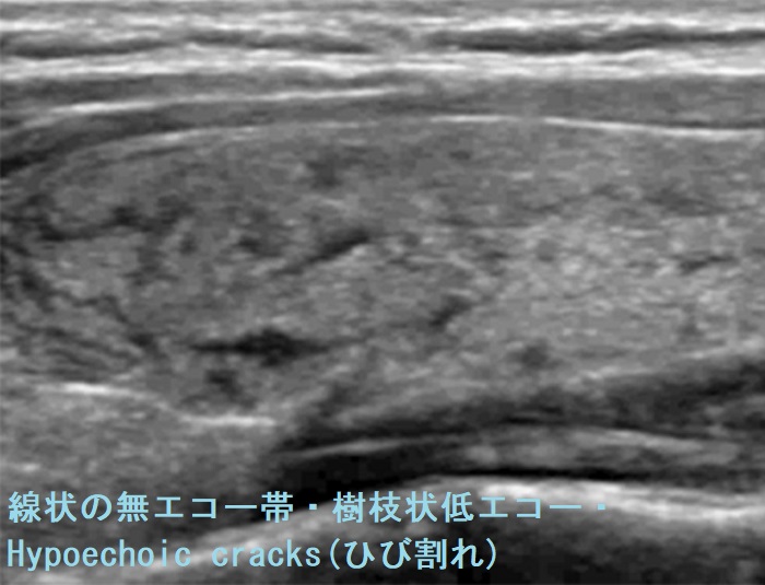 穿刺細胞診後、急激な甲状腺びまん性腫脹(急性反応、急性一過性甲状腺腫大)[長崎甲状腺クリニック大阪]