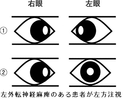 バセドウ病眼症(甲状腺眼症)と鑑別(視神経炎・眼神経障害)[橋本病 長崎甲状腺クリニック大阪]