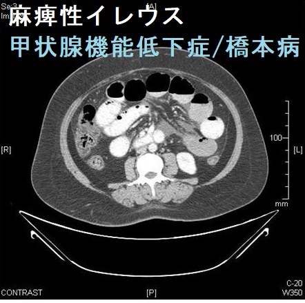 甲状腺と腸閉塞(イレウス)・ヘルニア(脱腸)・腸重積症[橋本病 バセドウ 長崎甲状腺クリニック 大阪