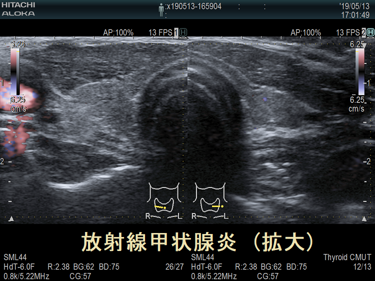 放射線誘発性甲状腺癌[橋本病 バセドウ病 甲状腺エコー検査