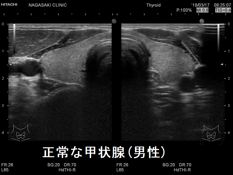 正常な甲状腺(男性) 超音波(エコー)画像