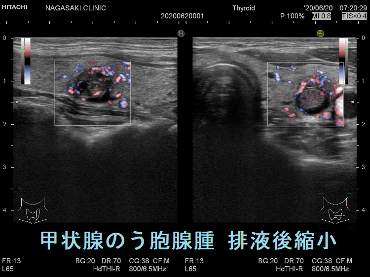 甲状腺のう胞腺腫 排液後縮小  超音波(エコー)画像 ドプラーモード