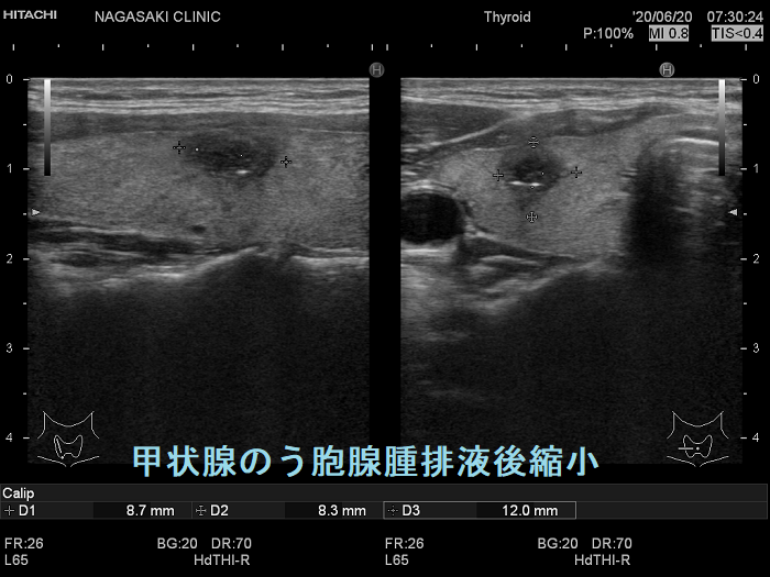 甲状腺のう胞腺腫排液後縮小 超音波(エコー)画像
