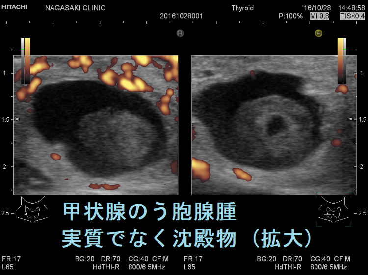 甲状腺のう胞腺腫 実質でなく沈殿物 超音波(エコー)画像(拡大) ドプラーモード