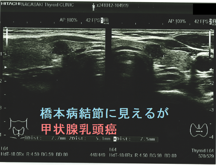 橋本病結節に見えるが甲状腺乳頭癌 橋本病結節に見えるが甲状腺乳頭癌
