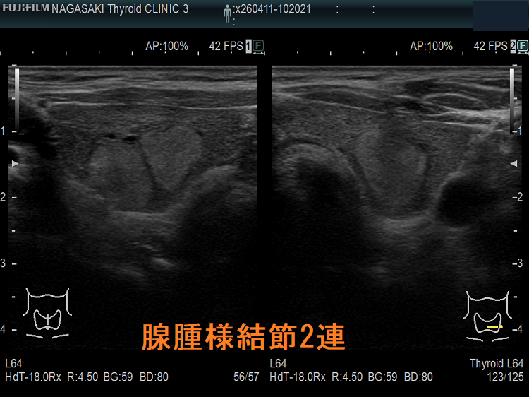 腺腫様結節2連 腺腫様結節2連1