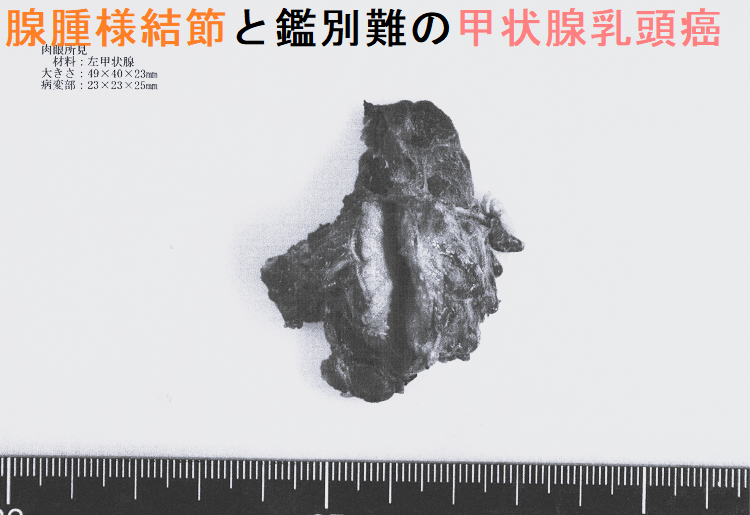 腺腫様結節と鑑別難の甲状腺乳頭癌 手術標本1 腺腫様結節と鑑別難の甲状腺乳頭癌 手術標本1