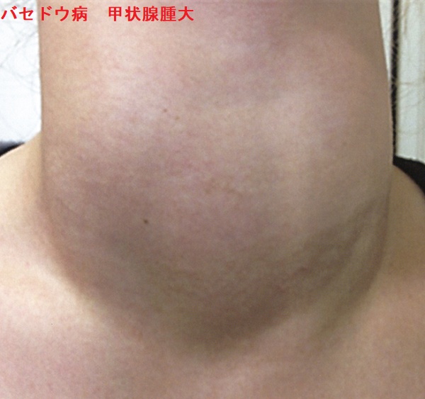 バセドウ病 甲状腺腫大（甲状腺の腫れ）