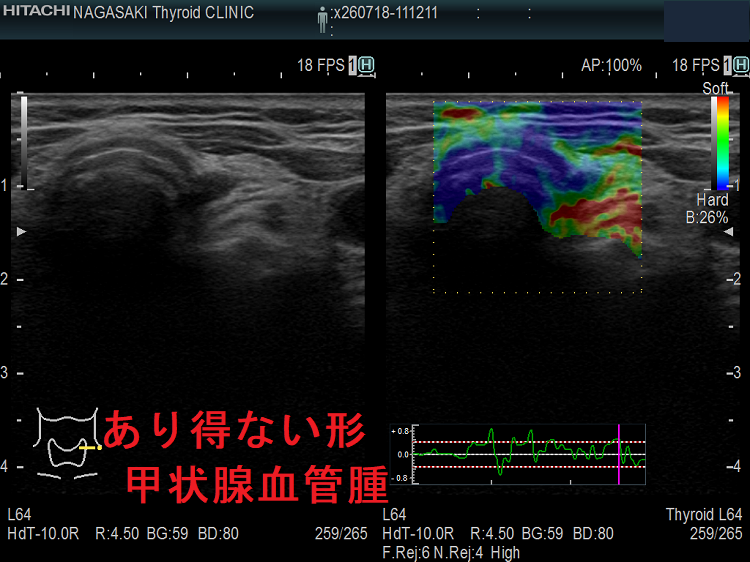 あり得ない形 甲状腺血管腫 エラストグラフィー