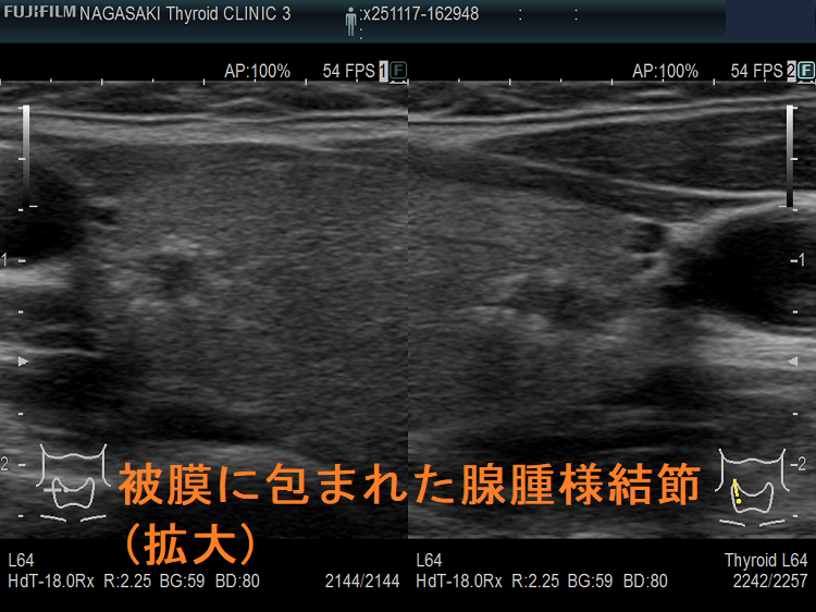 被膜に包まれた腺腫様結節(拡大) 被膜に包まれた腺腫様結節(拡大)