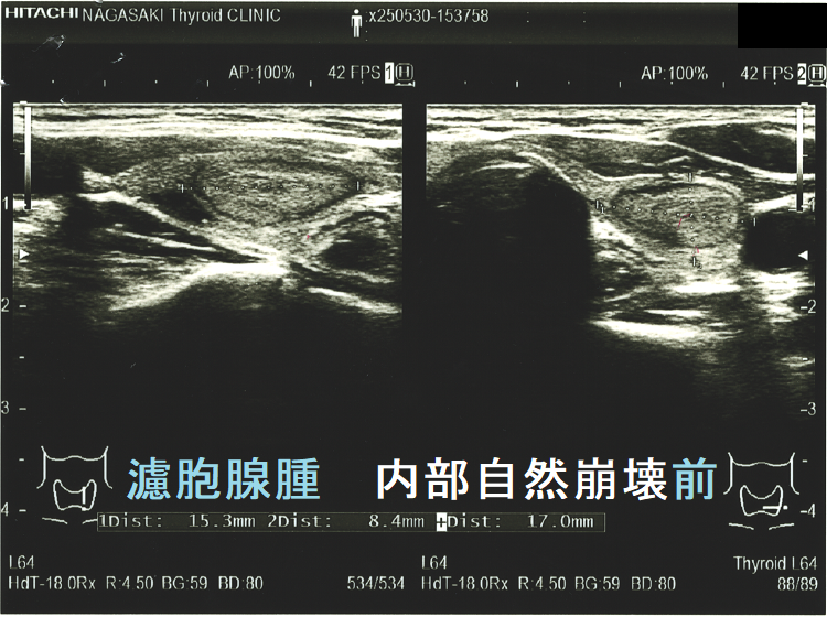 甲状腺濾胞腺腫 内部自然崩壊前 甲状腺濾胞腺腫 内部自然崩壊前
