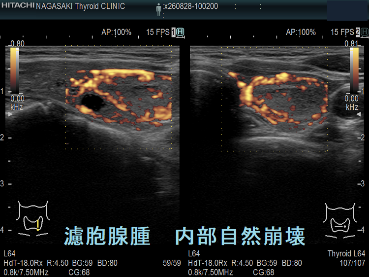 甲状腺濾胞腺腫 内部自然崩壊 ドプラーモード 甲状腺濾胞腺腫 内部自然崩壊 ドプラーモード