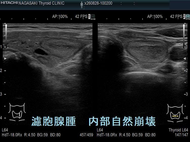 濾胞腺腫 内部自然崩壊 濾胞腺腫 内部自然崩壊
