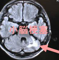 小脳梗塞 MRI画像
