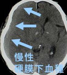 慢性硬膜下血腫 CT画像