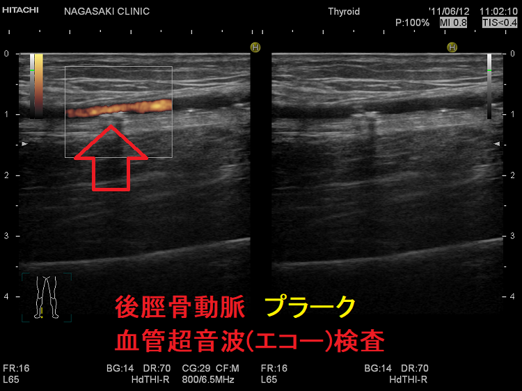 後脛骨動脈動脈 プラーク 血管超音波(エコー)検査