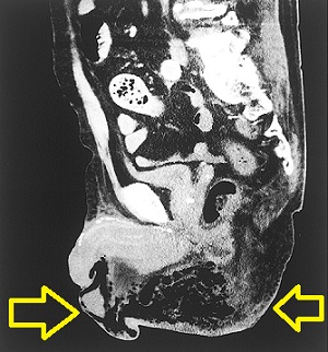 フルニエ壊疽（Fournier壊疽） CT画像