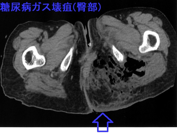 糖尿病ガス壊疽(臀部) 単純CT画像