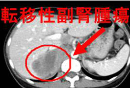 転移性副腎腫瘍　CT画像