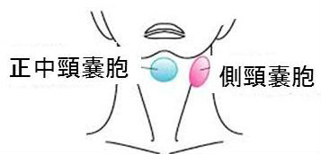 正中頸のう胞(甲状舌管嚢胞)