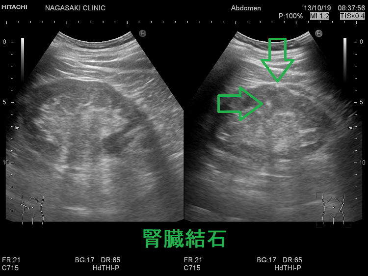 腎結石　超音波(エコー)画像