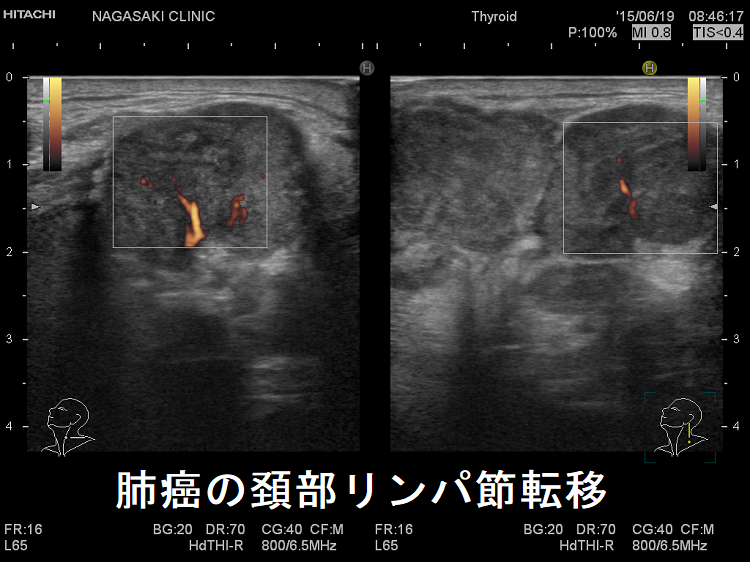肺癌の頚部リンパ節転移 超音波(エコー)画像