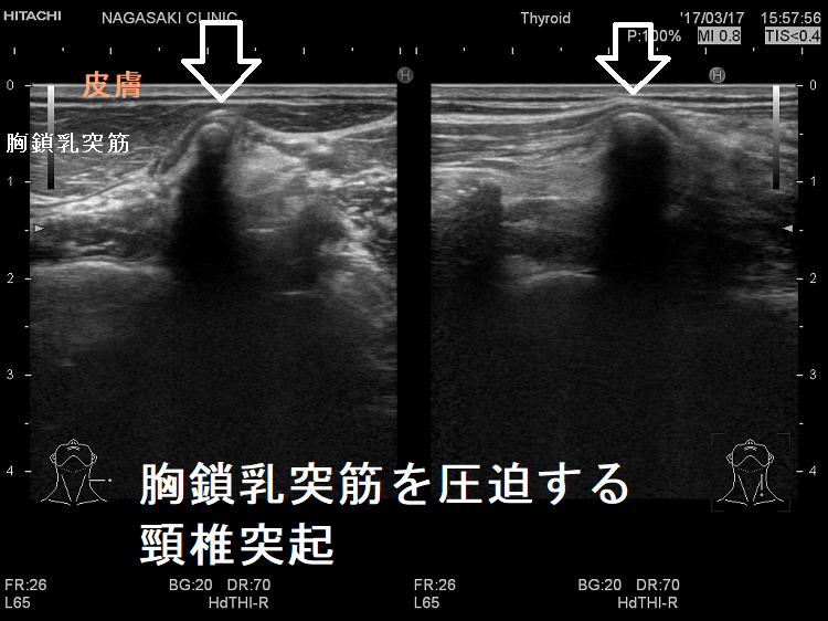 皮膚直下に頸椎突起 胸鎖乳突筋を圧迫 超音波(エコー)画像