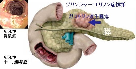膵内分泌腫瘍(ガストリノーマ)