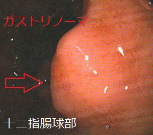 十二指腸球部のガストリノーマ