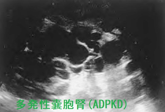 多発性嚢胞腎 超音波エコー画像