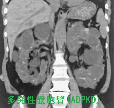 多発性嚢胞腎 CT画像