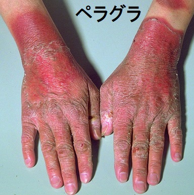 ペラグラ　皮膚症状