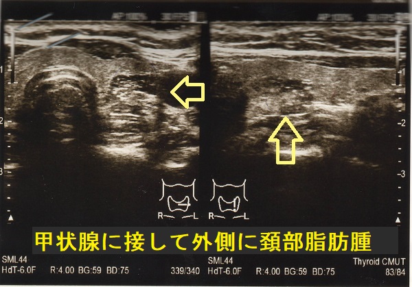 甲状腺に接して外側に頚部脂肪腫 超音波(エコー)画像