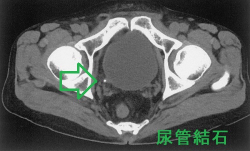  尿管結石 CT画像