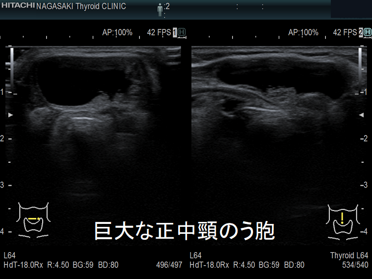 巨大な正中頸のう胞(甲状舌管嚢胞)  超音波（エコー）画像