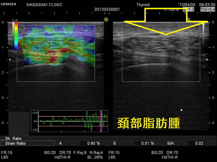 頚部脂肪腫 超音波(エコー)画像