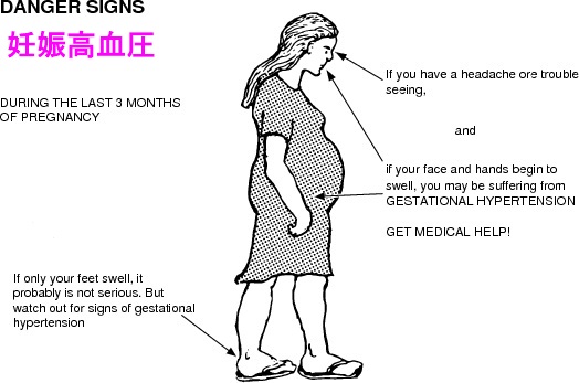 妊娠高血圧