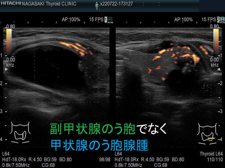 副甲状腺のう胞でなく甲状腺のう胞腺腫 超音波（エコー）画像 ドプラーモード