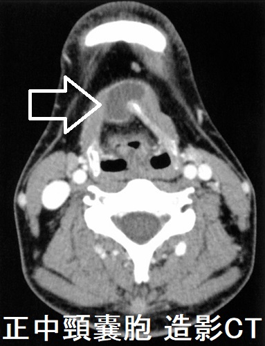 正中頸嚢胞 造影CT画像（水平断）
