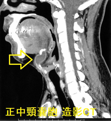 正中頸嚢胞 造影CT画像（矢状断）