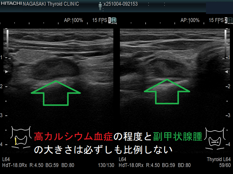 高カルシウム血症の程度と副甲状腺腫の大きさは必ずしも比例しない 高カルシウム血症の程度と副甲状腺腫の大きさは必ずしも比例しない