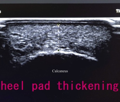 heel pad thickening heel pad thickening